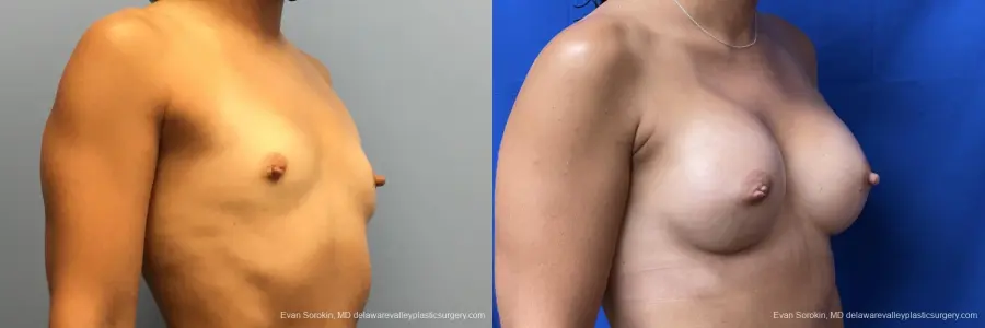 Breast Augmentation: Patient 180 - Before and After 2