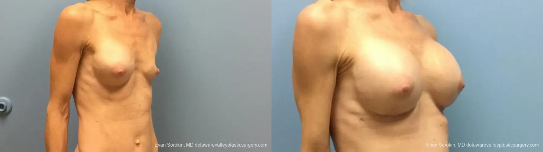 Philadelphia Breast Augmentation 13182 - Before and After 4