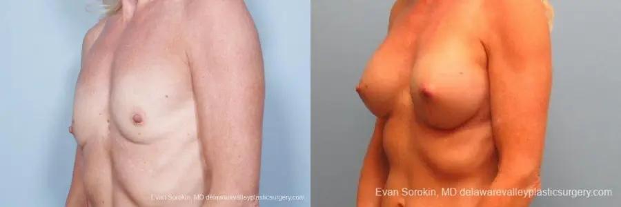 Philadelphia Breast Augmentation 9415 - Before and After 4