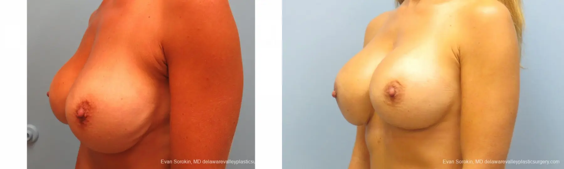 Breast Augmentation Revision: Patient 10 - Before and After 2