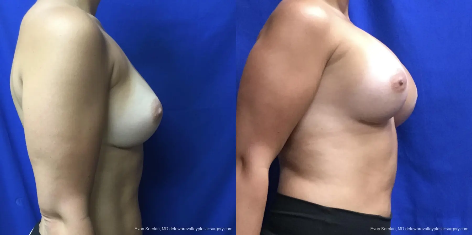 Breast Augmentation: Patient 206 - Before and After 3