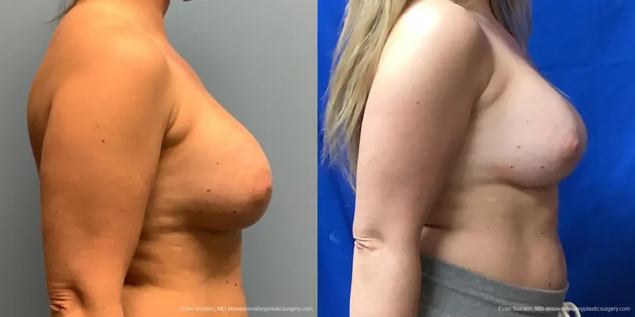Breast Augmentation: Patient 225 - Before and After 5