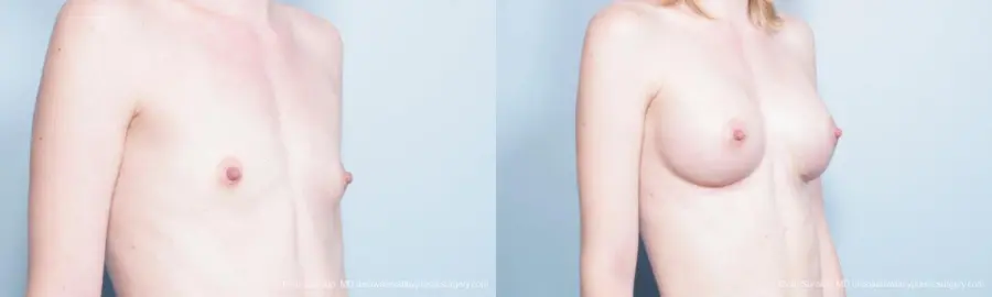 Philadelphia Breast Augmentation 9300 - Before and After 2