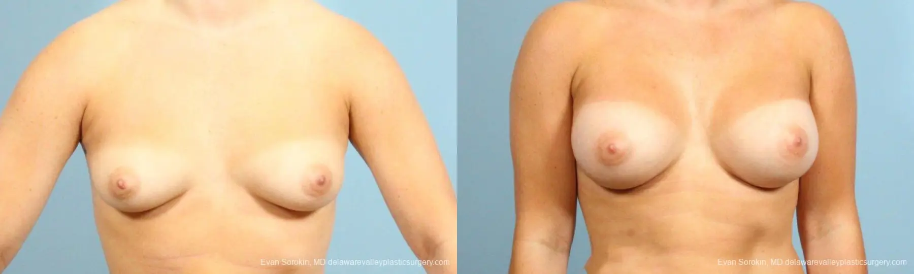 Philadelphia Breast Augmentation 8650 - Before and After 1