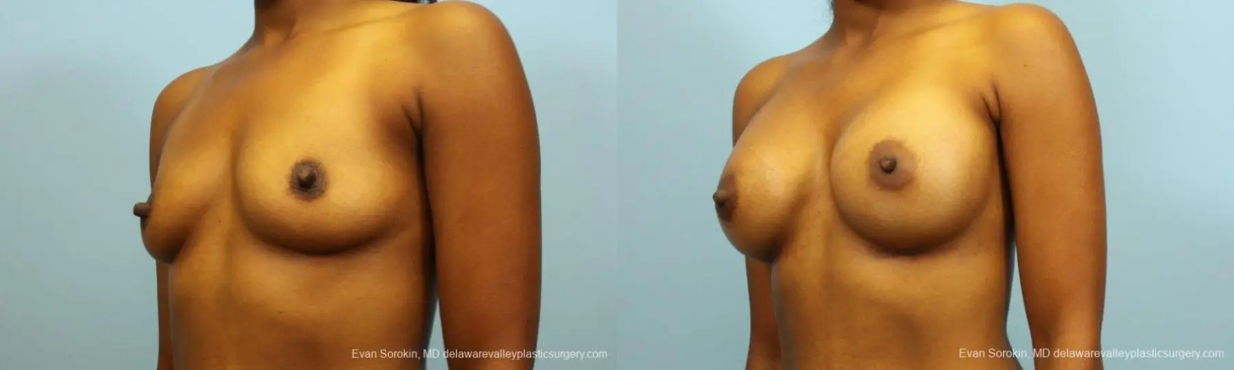 Philadelphia Breast Augmentation 8768 - Before and After 4