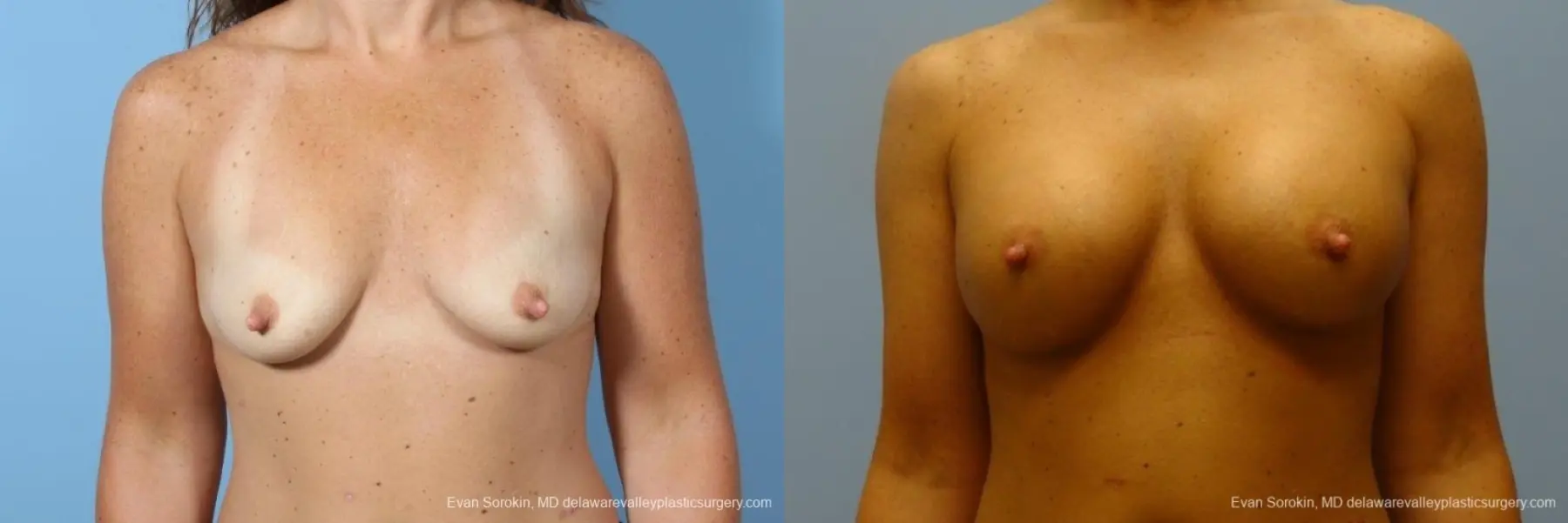 Philadelphia Breast Augmentation 8774 - Before and After 1