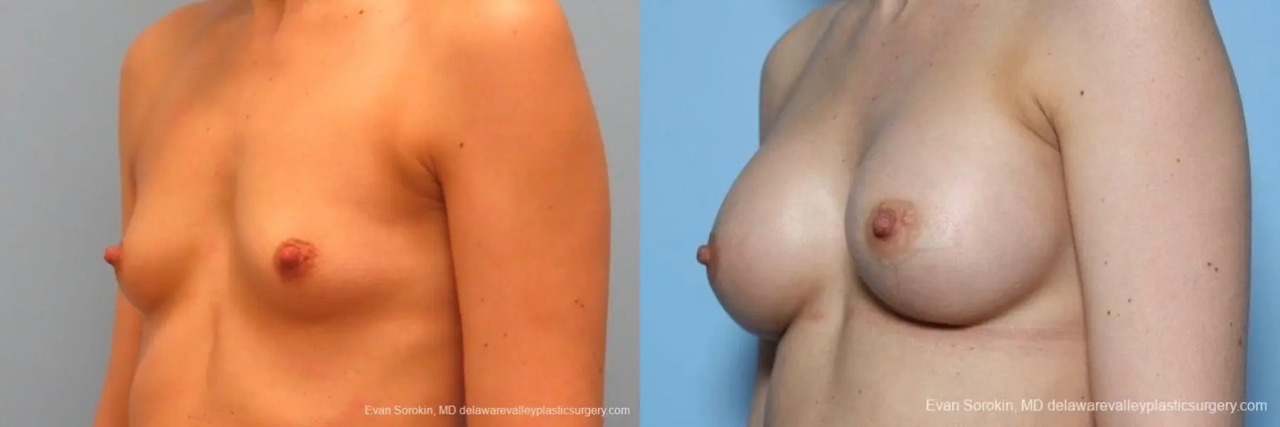 Philadelphia Breast Augmentation 8763 - Before and After 3