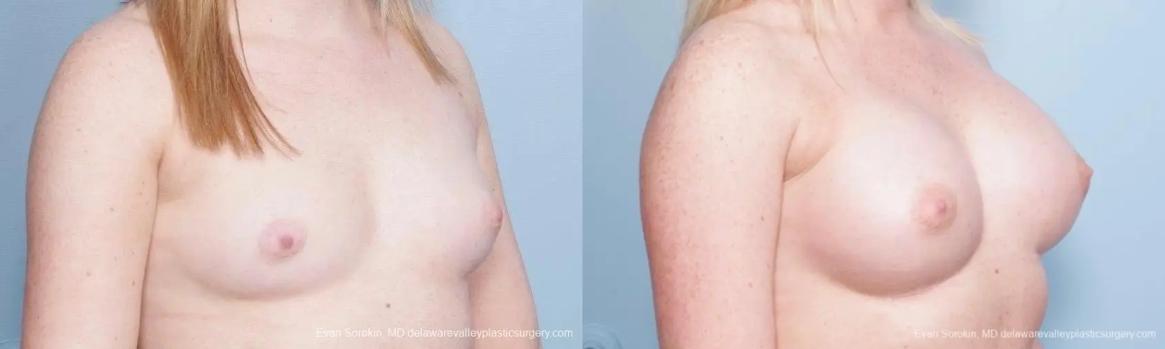 Philadelphia Breast Augmentation 8778 - Before and After 2