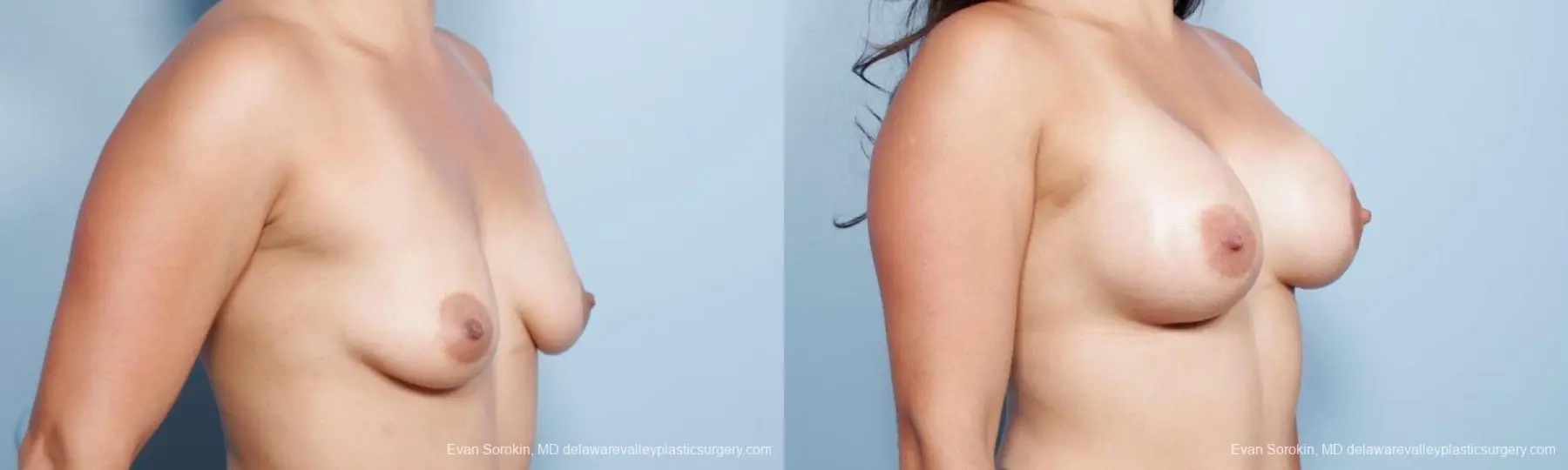 Philadelphia Breast Augmentation 9297 - Before and After 2