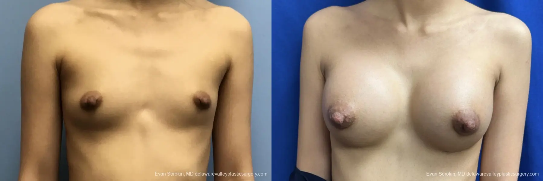Breast Augmentation: Patient 251 - Before and After 1