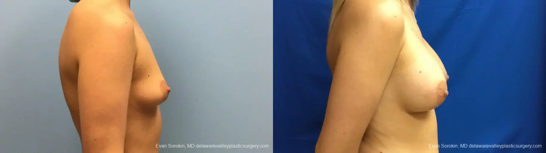 Philadelphia Breast Augmentation 12540 - Before and After 4