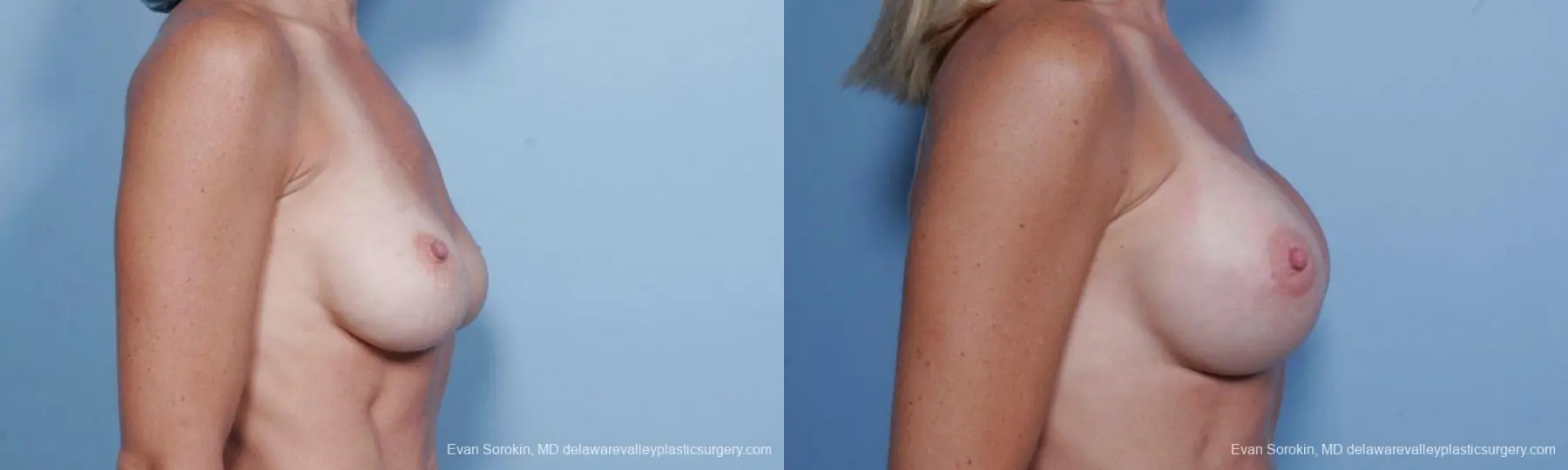 Philadelphia Breast Augmentation 9454 - Before and After 3