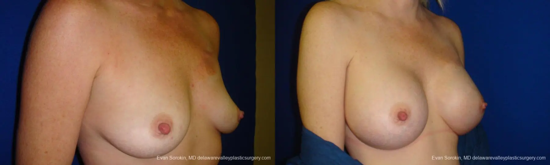 Philadelphia Breast Augmentation 9295 - Before and After 2