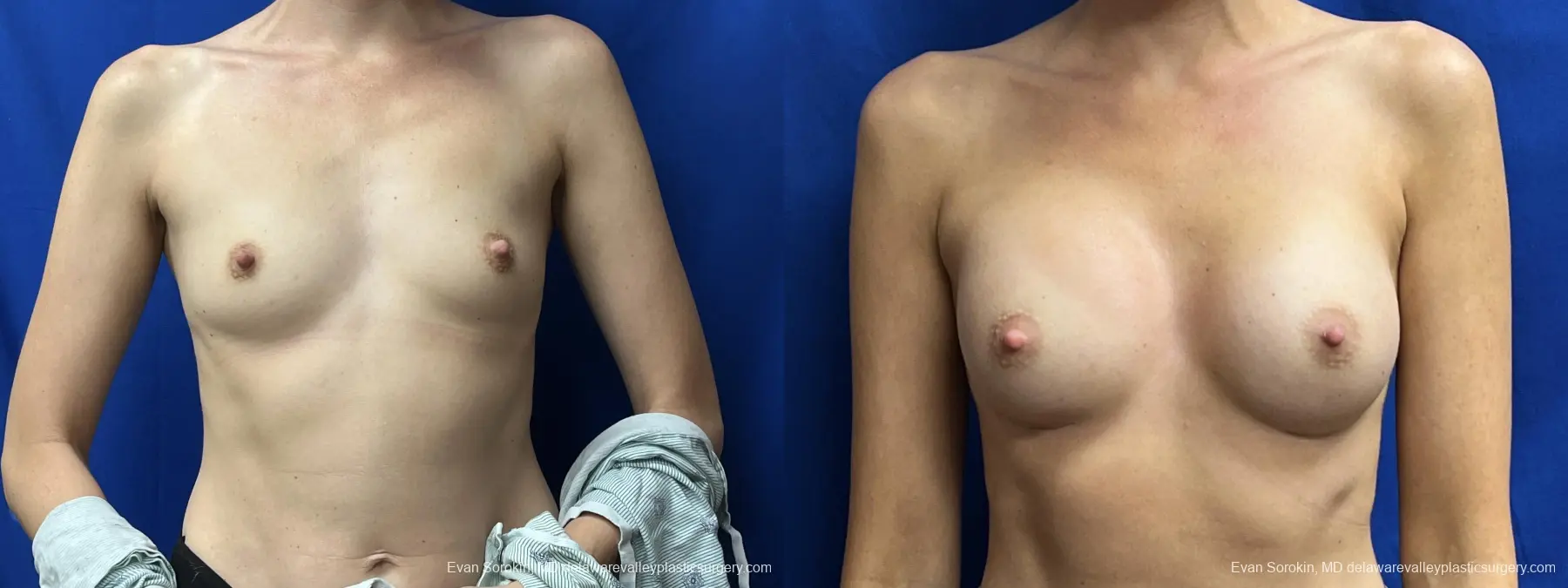 Breast Augmentation: Patient 203 - Before and After 1