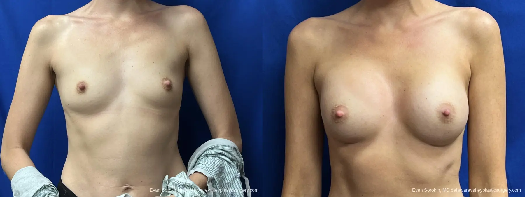 Breast Augmentation: Patient 205 - Before and After 1