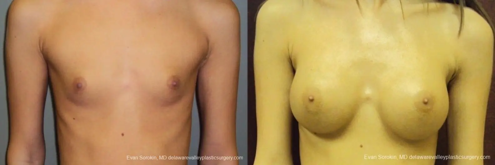 Philadelphia Breast Augmentation 8668 - Before and After 1