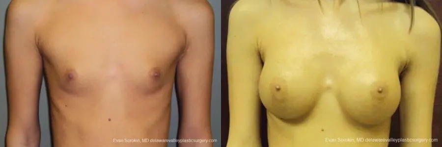 Philadelphia Breast Augmentation 8668 - Before and After 1