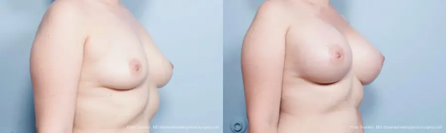 Philadelphia Breast Augmentation 9419 - Before and After 2
