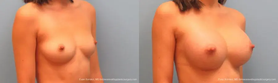 Philadelphia Breast Augmentation 9342 - Before and After 2