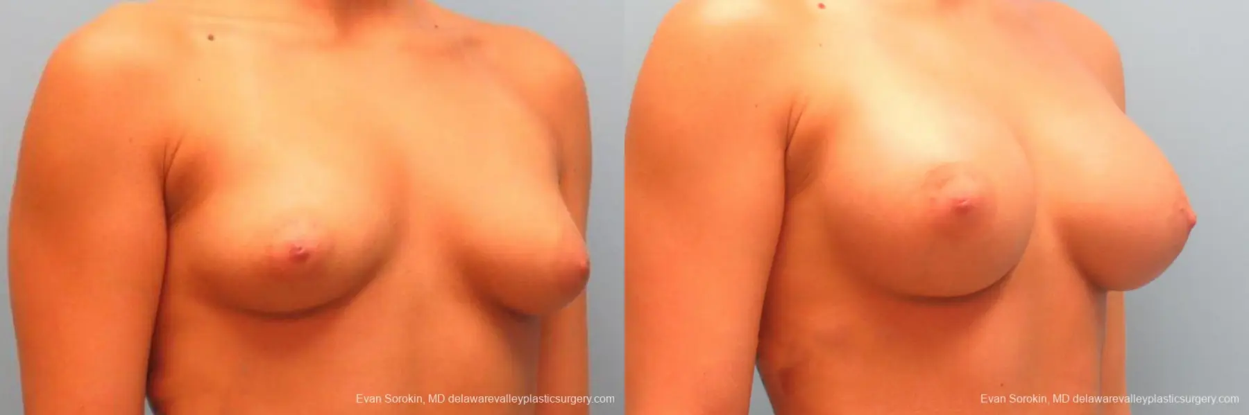 Philadelphia Breast Augmentation 9344 - Before and After 2