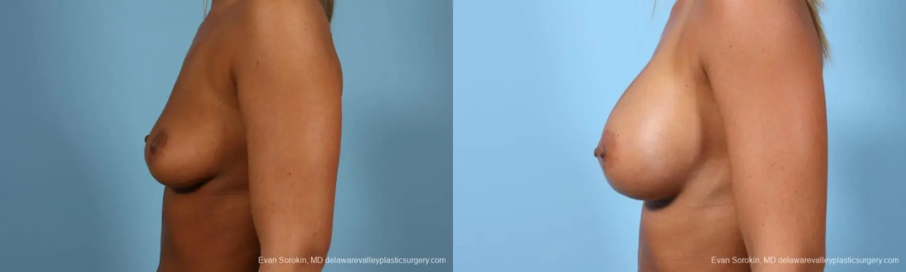 Philadelphia Breast Augmentation 9404 - Before and After 5