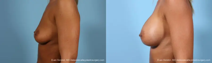 Philadelphia Breast Augmentation 9404 - Before and After 5