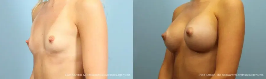 Philadelphia Breast Augmentation 9409 - Before and After 4