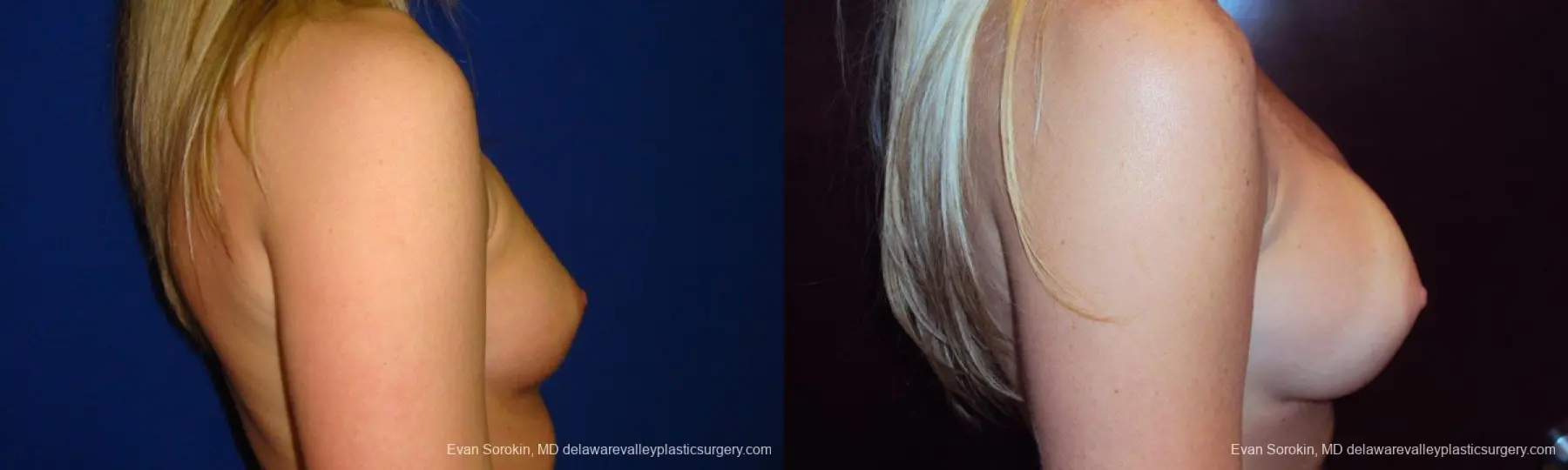 Philadelphia Breast Augmentation 9293 - Before and After 3