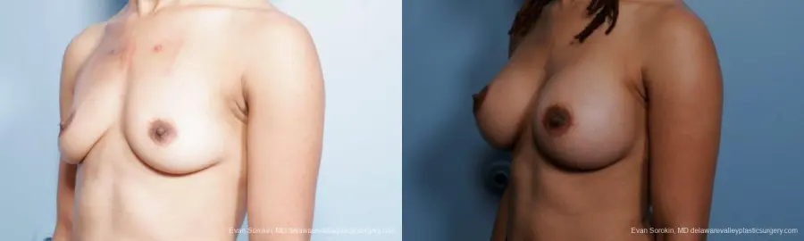 Philadelphia Breast Augmentation 9305 - Before and After 4