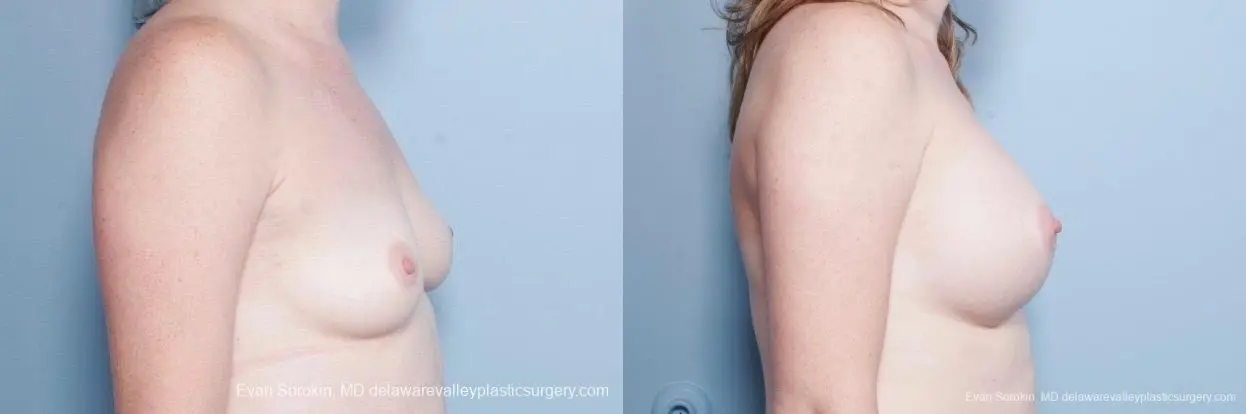 Philadelphia Breast Augmentation 8795 - Before and After 4