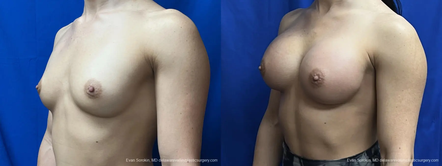 Breast Augmentation: Patient 202 - Before and After 4