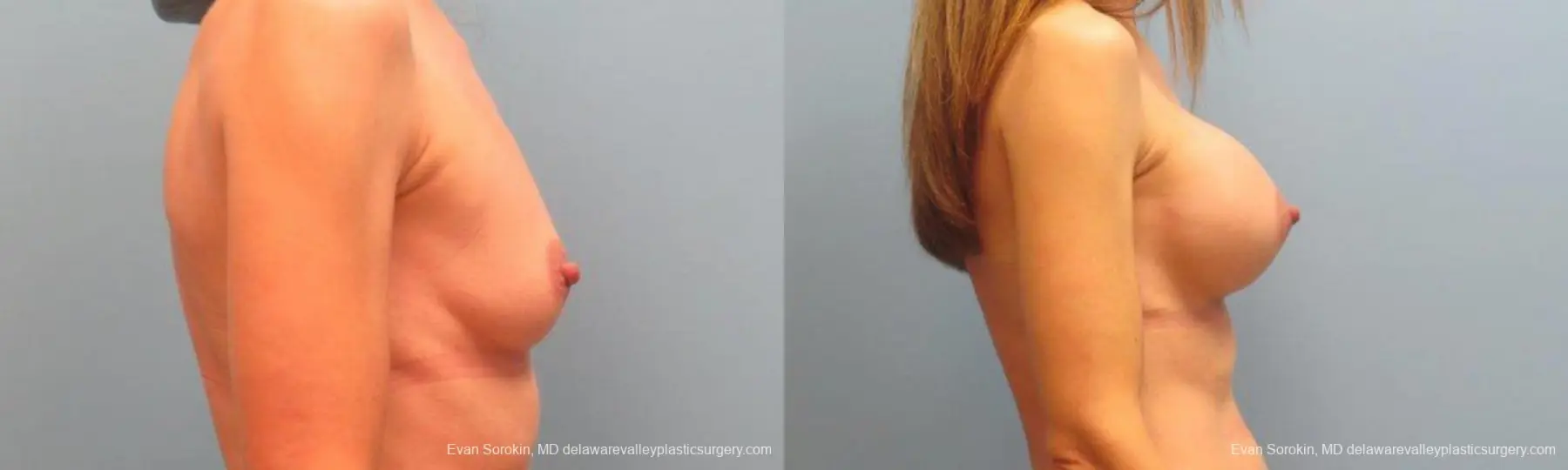 Philadelphia Breast Augmentation 9368 - Before and After 3