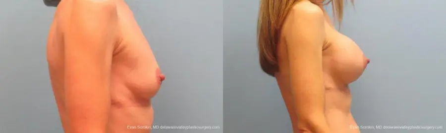 Philadelphia Breast Augmentation 9368 - Before and After 3