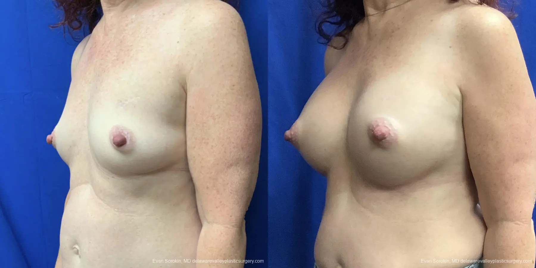 Breast Augmentation: Patient 176 - Before and After 4