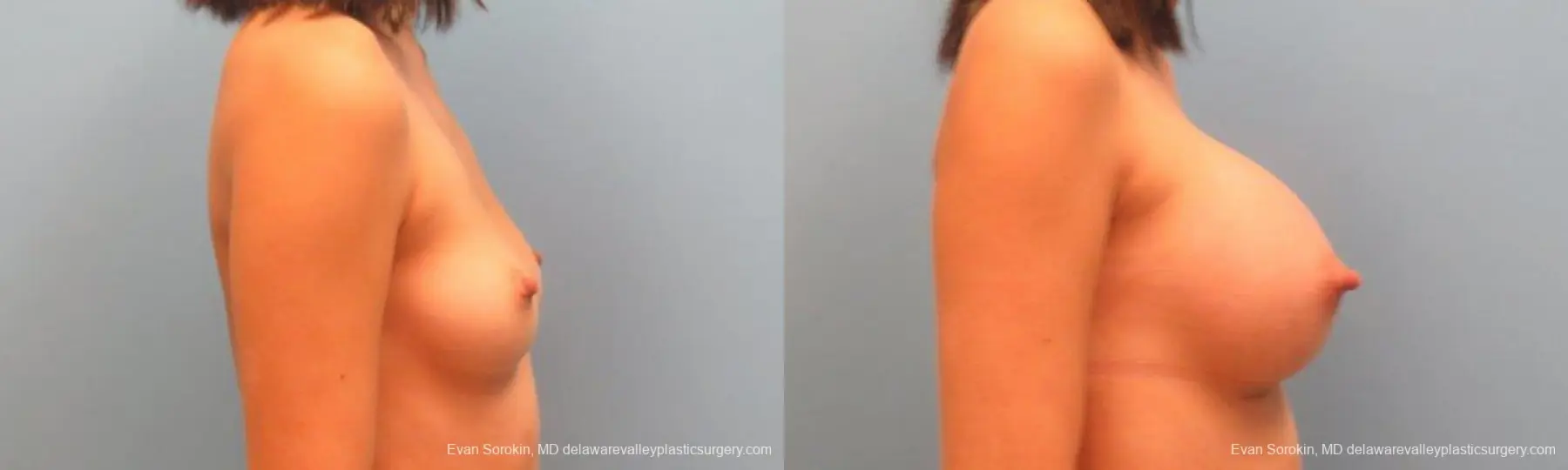 Philadelphia Breast Augmentation 9342 - Before and After 3