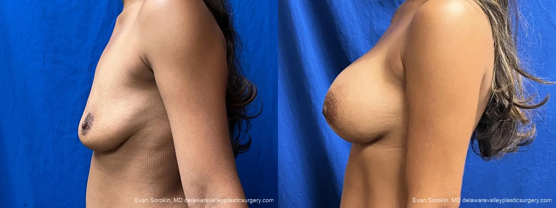 Breast Augmentation: Patient 308 - Before and After 5