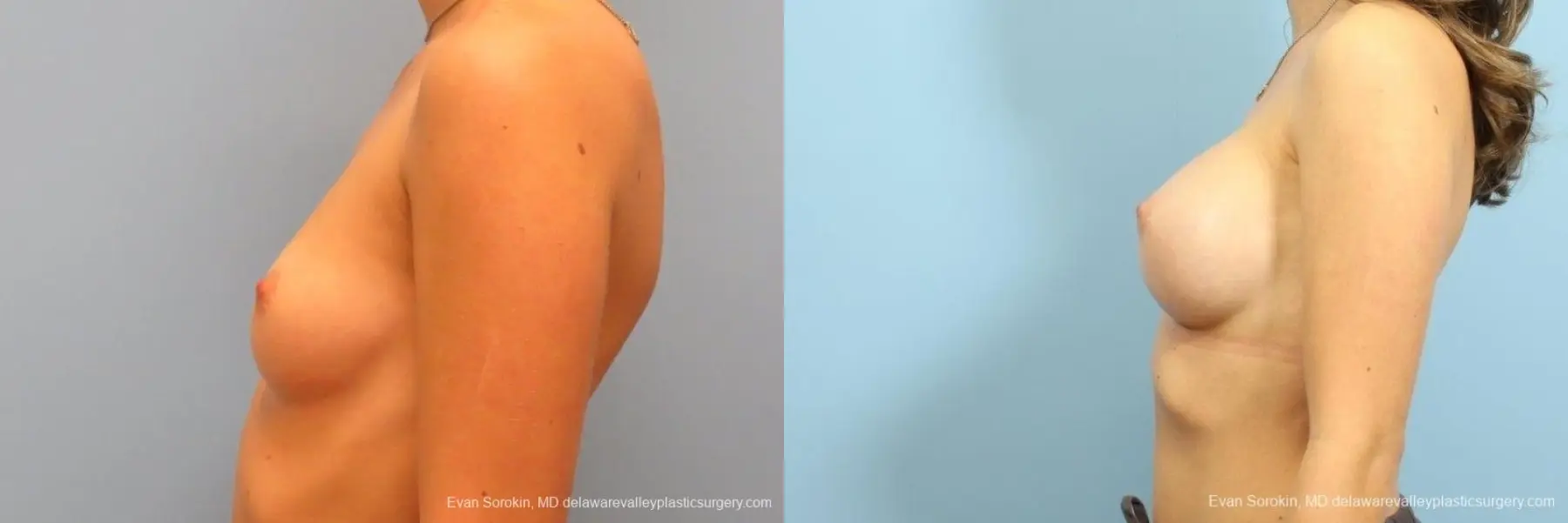 Philadelphia Breast Augmentation 8666 - Before and After 5