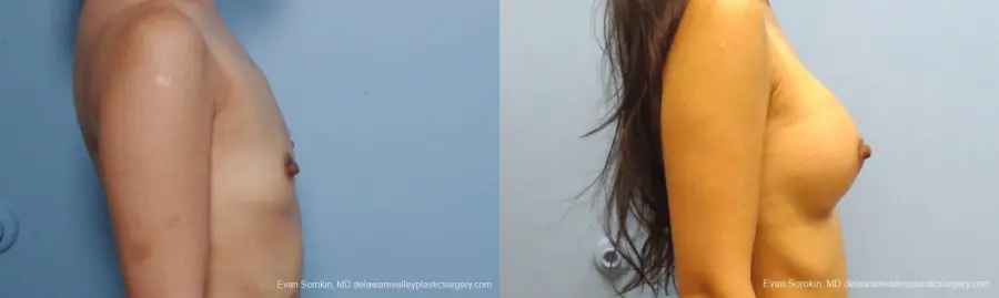 Philadelphia Breast Augmentation 8661 - Before and After 4