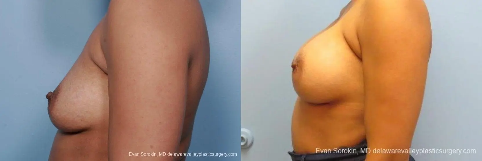 Philadelphia Breast Augmentation 9387 - Before and After 5