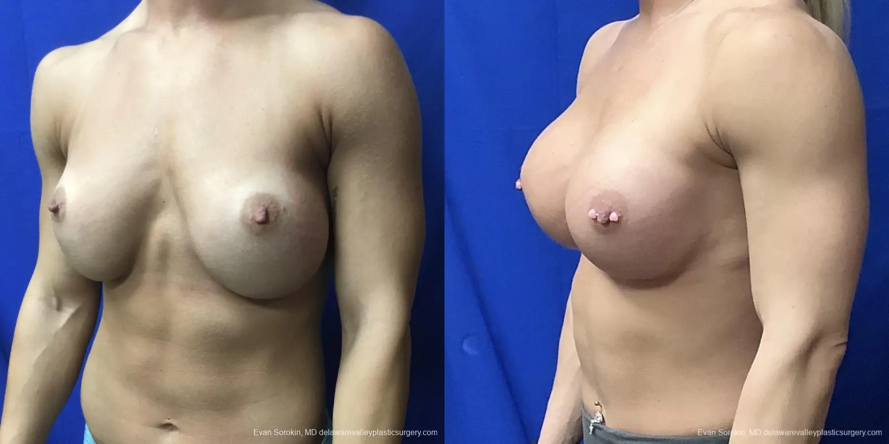 Breast Augmentation: Patient 213 - Before and After 4