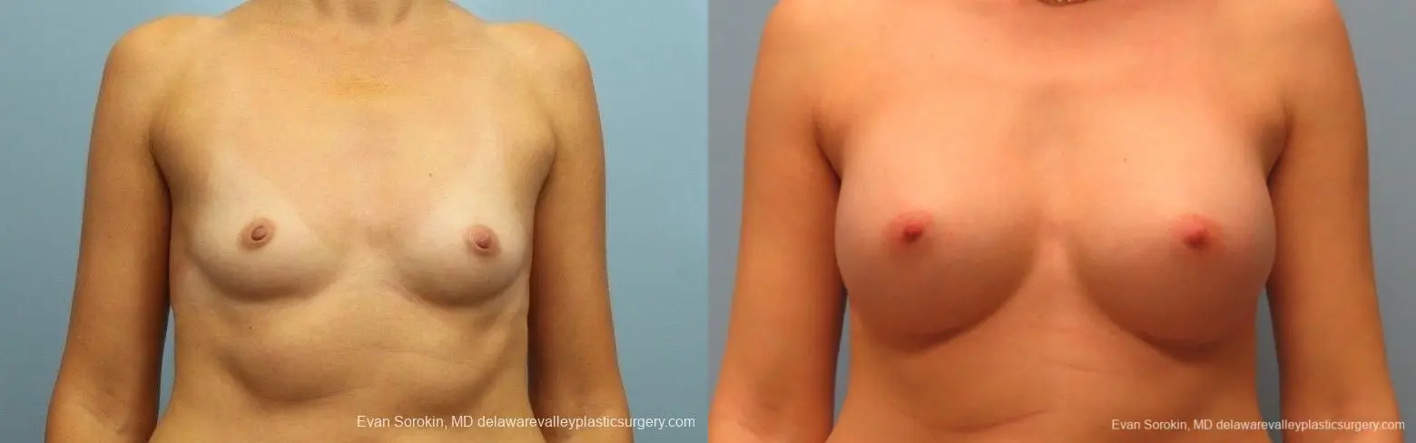 Philadelphia Breast Augmentation 8764 - Before and After 1