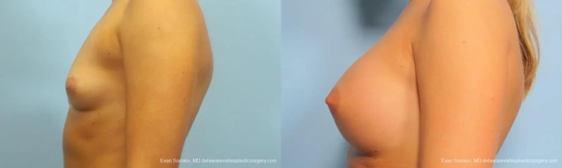 Philadelphia Breast Augmentation 9183 - Before and After 5