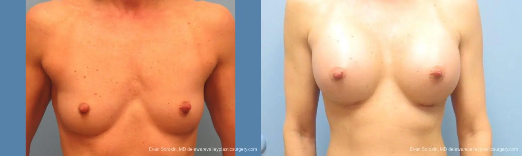 Philadelphia Breast Augmentation 9744 - Before and After 1