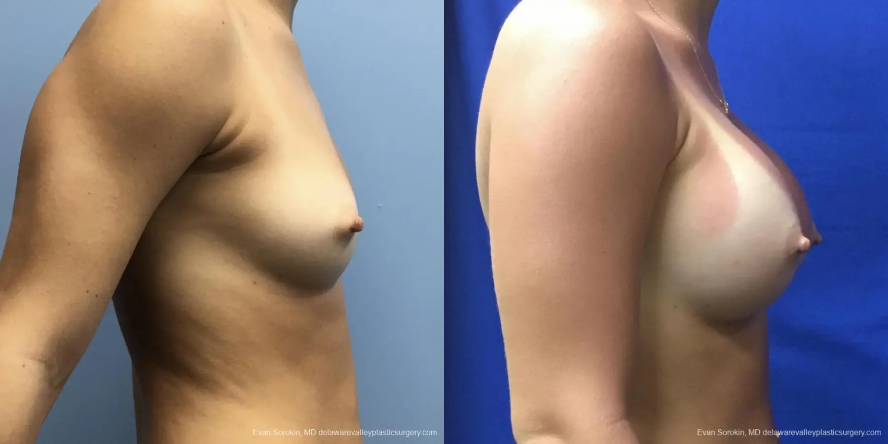 Breast Augmentation: Patient 166 - Before and After 3
