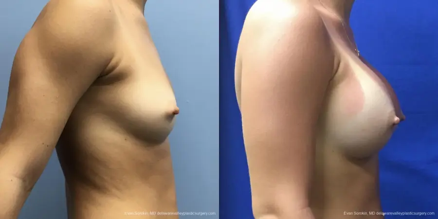 Breast Augmentation: Patient 165 - Before and After 3