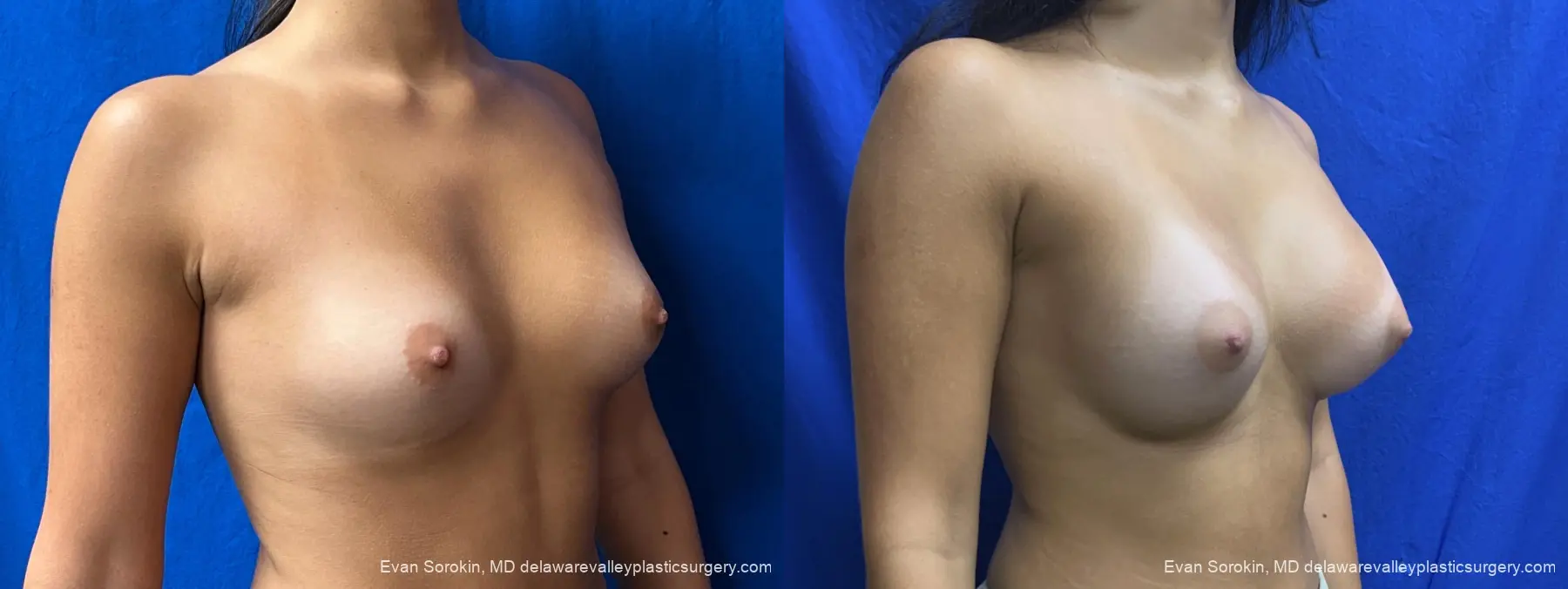Breast Augmentation: Patient 314 - Before and After 2