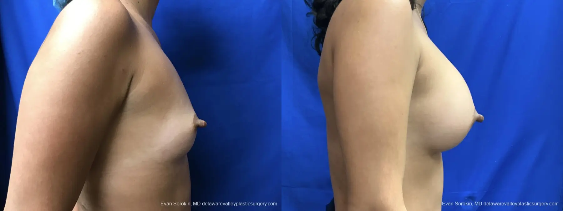 Breast Augmentation: Patient 208 - Before and After 3