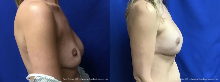 Breast Augmentation: Patient 233 - Before and After 4