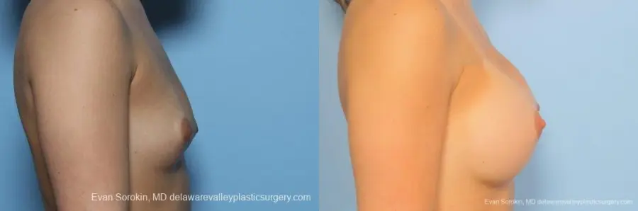 Philadelphia Breast Augmentation 8773 - Before and After 4