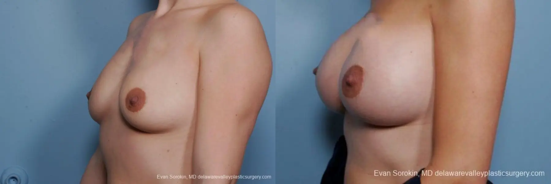 Philadelphia Breast Augmentation 9385 - Before and After 4